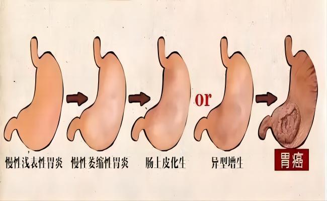从胃炎到胃癌，大概需要几年？提醒：警惕5个癌变信号，及时调理