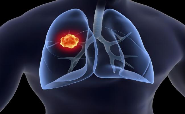 警惕肺癌